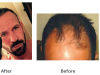 Hair Transplants of Florida