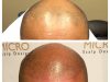 Micro Scalp Design