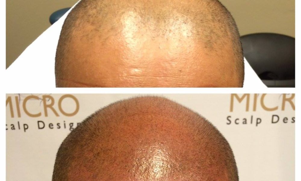 Micro Scalp Design