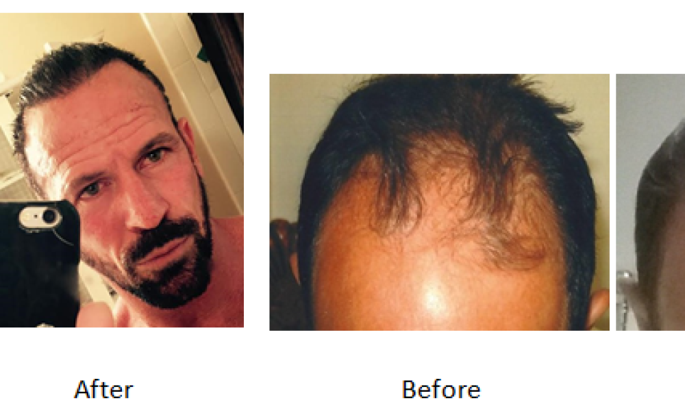 Hair Transplants of Florida